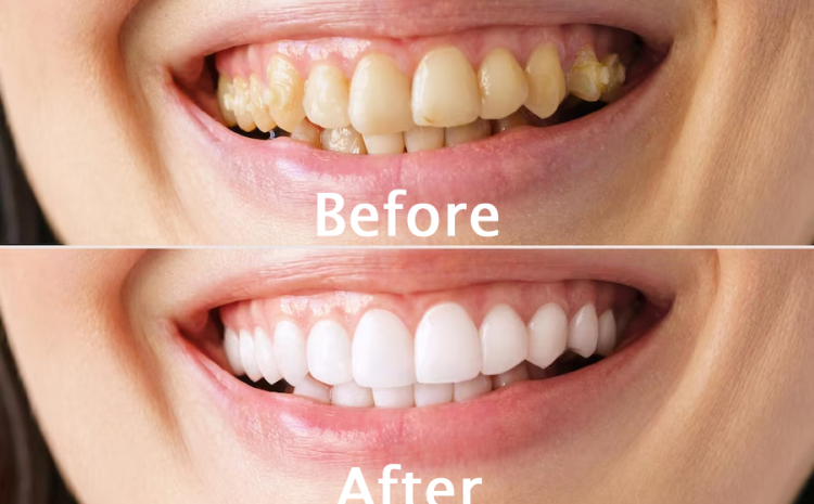 Scaling and Polishing
